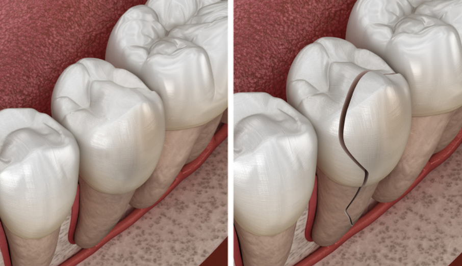 مینای دندان