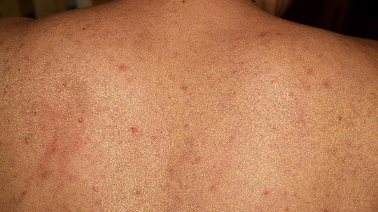 درمان جوش و آکنه کمر