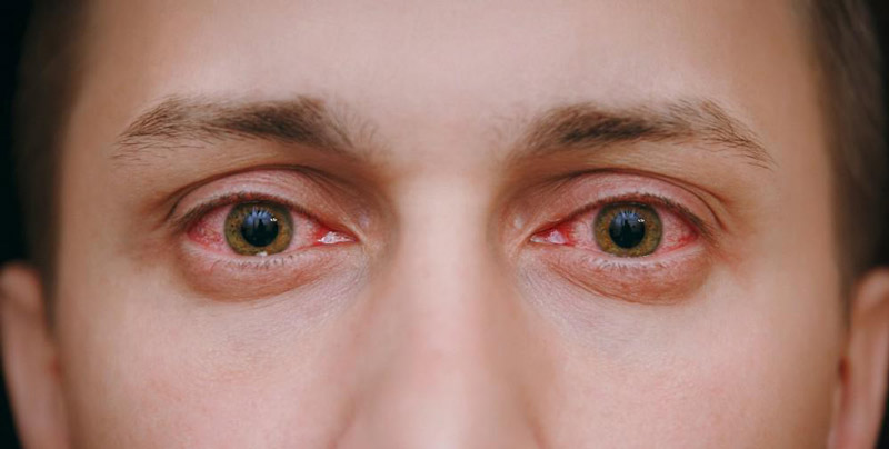علت قرمزی چشم چیست ؟
