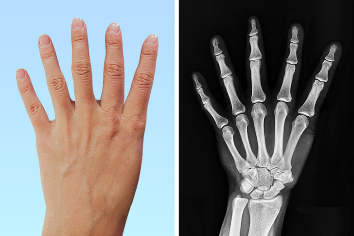 داشتن شست با ۳ بند یا داشتن انگشت ششم