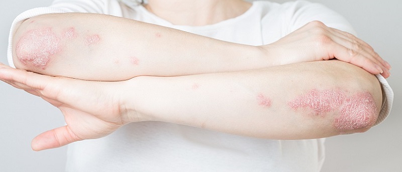 بیماری پوستی