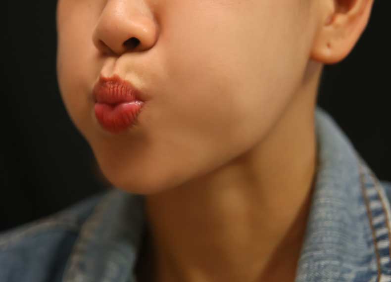 چاق شدن صورت بدون فیلر و ژل