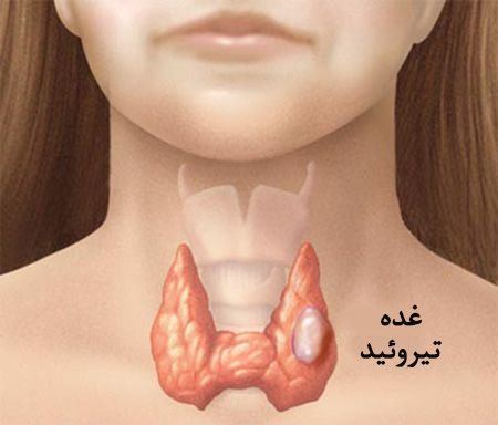 آیا کم کاری تیروئید باعث سقط جنین میشود؟