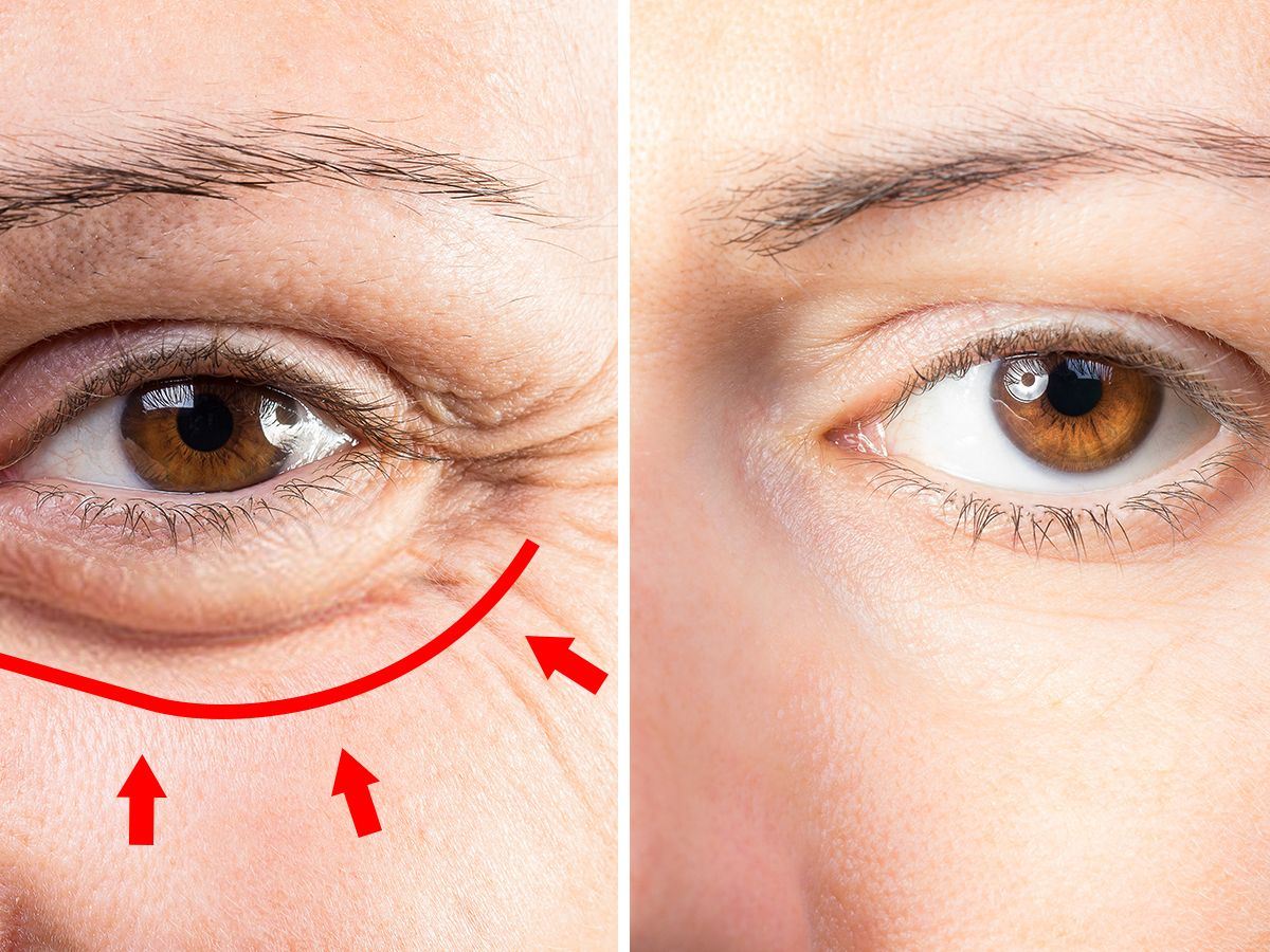 علت پف زیر چشم ها چیست؟