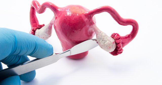 تنبلی تخمدان