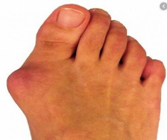 چگونه انحراف انگشت شست پا را درمان کنیم؟