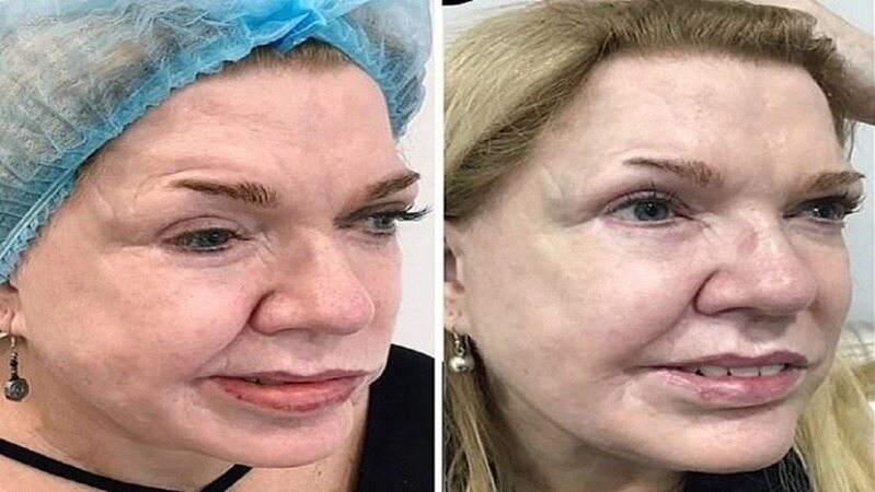 تزریق بوتاکس نقص ۱۹ ساله صورت یک زن را اصلاح کرد + تصویر