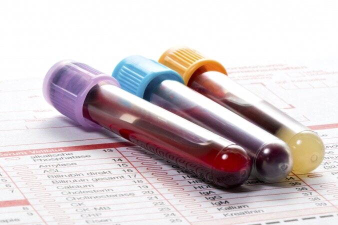 در خانه آزمایش خونتان را تفسیر کنید تا بفهمید کم خونی دارید یا نه
