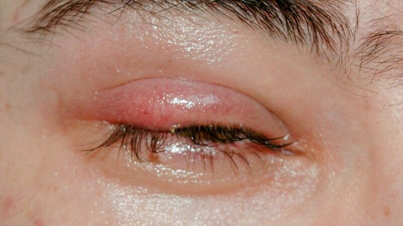 گل مژه را با این دارو های گیاهی درمان کنید