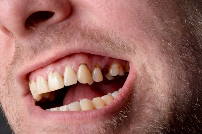 7 اشتباهی که سرعت پوسیدگی دندان های شما را 10 برابر میکند !