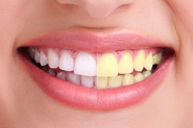 اگر دندان های سفیدی می خواهید خمیر دندان خود را با نارگیل جایگزین کنید