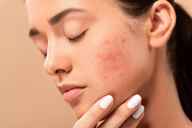 جوش زدن در نقاط مختلف صورت نشان دهنده چیست؟