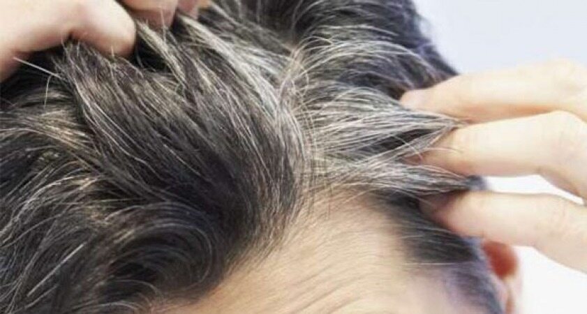 دلایل سفید شدن مو‌ و راهکار درمان آن چیست؟