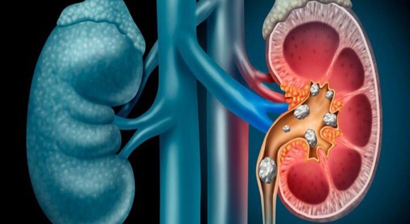 چند عامل بسیارخطرناک که باعث ایجاد سنگ کلیه های دردناک می شود