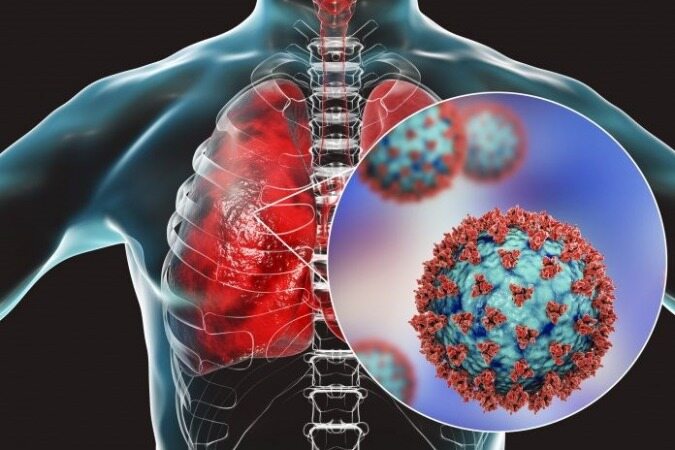 علائم درگیری ریه در مبتلایانِ  کرونا