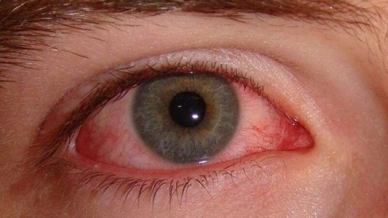 ماجرای تست چشم از زائران اربعین؛ ۵ درصد بیماران کرونایی علائم چشمی دارند