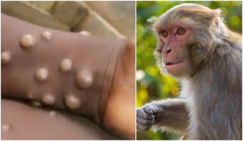 شناسایی اولین مورد ابتلا به آبله میمونی در امارات