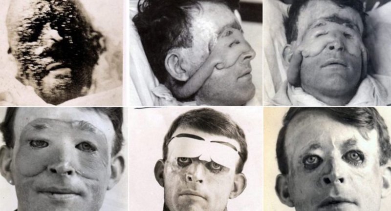 تصاویر دلهره آور از جراحی زیبایی مجروحان جنگ جهانی اول + (تصاویر 18-)