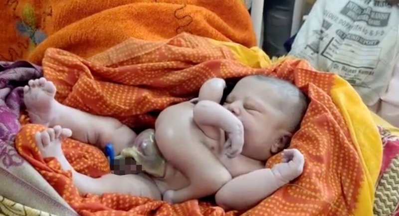 تولد نوزاد عجیب الخلقه چهار دست و پا در هند + تصویر
