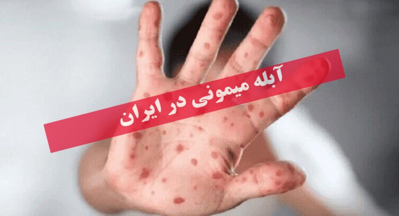 جزئیات جدید از زن ایرانی مبتلا به آبله میمونی در اهواز