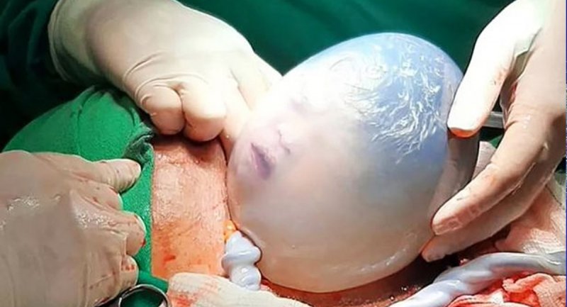 برای اولین بار تولد یک نوزاد در حالی که کیسه آب هنوز کاملاً سالم است + تصاویر