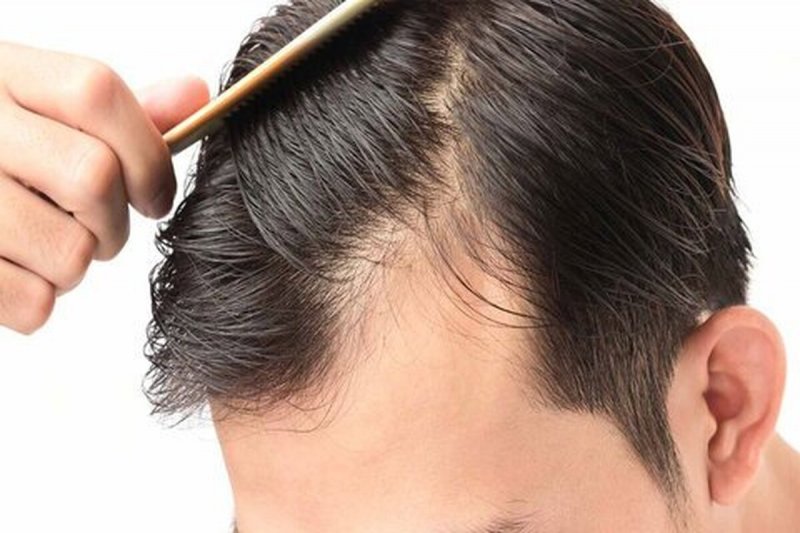 چگونه بدانیم ریزش موی سر غیر طبیعی است