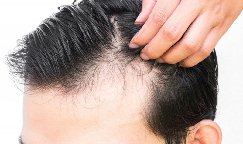 این عامل تشدیدکننده ریزش مو در مردان
