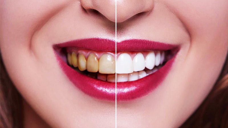 با 3 روش ساده و کم هزینه دندانهایتان را در خانه جرم گیری کنید