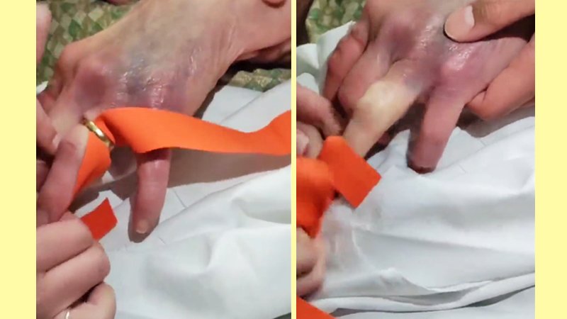 روشی ساده برای در آوردن حلقه هنگام ورم کردن انگشت+ ویدیو