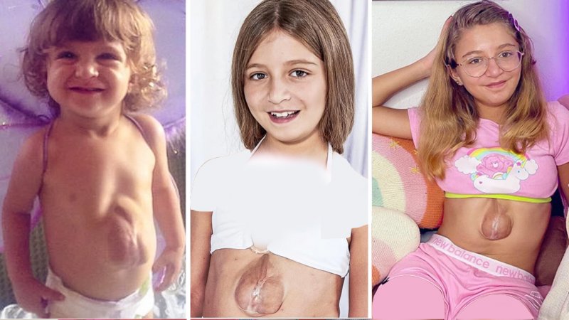 زندگی عجیب دختری که با ضربان قلب بیرون از سینه متولد شد!+ تصاویر