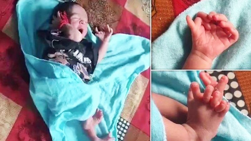تولد نوزادی با ۲۶ انگشت که خانواده اش او را یک الهه می‌دانند + تصایر