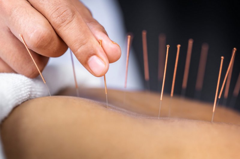  آیا طب سوزنی واقعا در کاهش درد سیاتیک موثر است؟